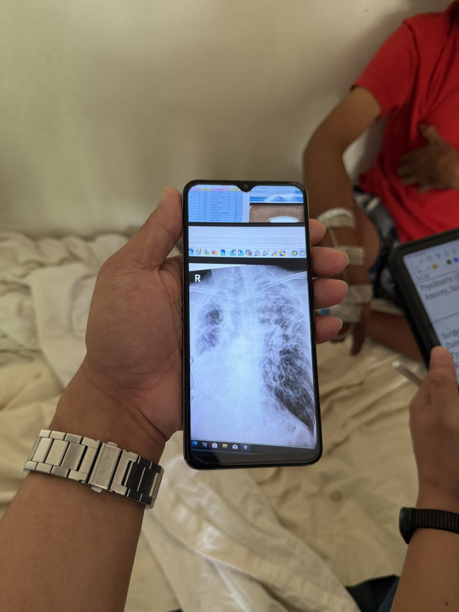 akoposimarkynyo's tweet photo. His heart is on the right. First time ko makaencounter ng ganitong patient. 

Photo taken with the patient’s consent. https://t.co/oJYxWgAnM5