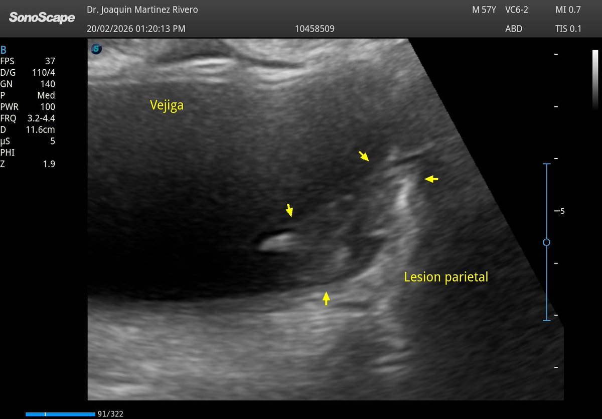 JMMR83's tweet photo. Lesión vesical
@NephroP @OswaldoRamosN @javiteigell @y_interna @yaletung @SonoSamMD @curromir @zbriote @ABCDEcografia @PierpaDiNick @jpalacinp @jorgezzb @AlvarezHigueras @ignaciomsb @Rad_Munagi @drvaque_eco @mberchid @EcosemfyC @USPed_Latam @GTECOSEMI @GTEcoPed @GTEcoSemergen https://t.co/QV4wVzTYMa