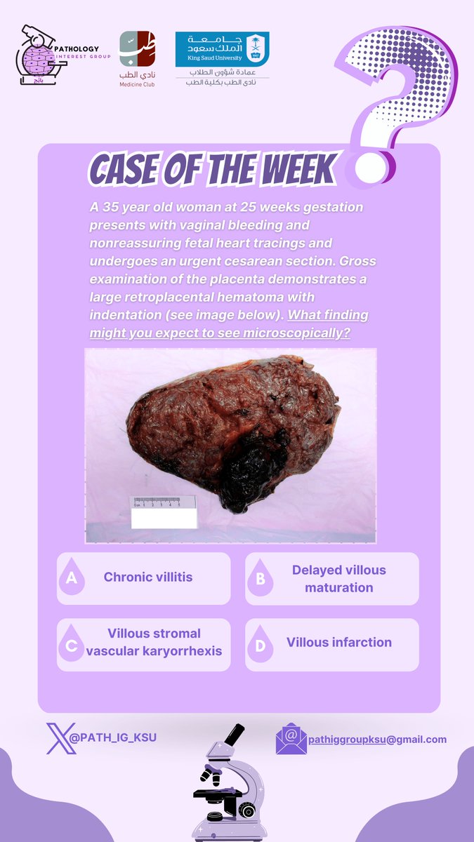 PATH_IG_KSU's tweet image. 👉 What microscopic finding would you expect?