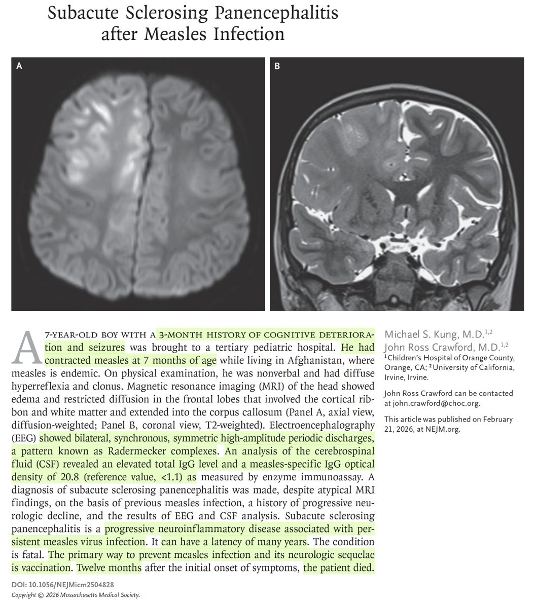 A potential late sequelae of measles after normal recovery.
Occurs in ~ 2/10,000. Fatal.
nejm.org/doi/full/10.10… <a href="/NEJM/">NEJM</a> today