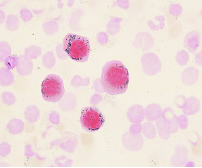 Papa_Heme's tweet photo. Sideroblastic Anemia!

Sideroblast = erythroblast (developing RBC) with iron-loaded mitochondria appear perinuclear granules when stained with Prussian blue

Pathologic = ring sideroblast = iron-laden mitochondria form a complete or partial ring around the nucleus

Anemia + bone marrow with ring sideroblast DDx
Divide by acquired vs neopalstic vs inherited

Acquired:
Drugs/toxin = EtOH, Pb
⬇️nutrtient = Cu, B6

Neoplastic:
MDS =  RARS (SF3B1 mut)
MDS/MPN overlap = RARS-T (thrombocytosis)

Inherited:
XLSA = ALAS2 mutation
Pearson syndrome
Thiamine response megaloblastic anemia
