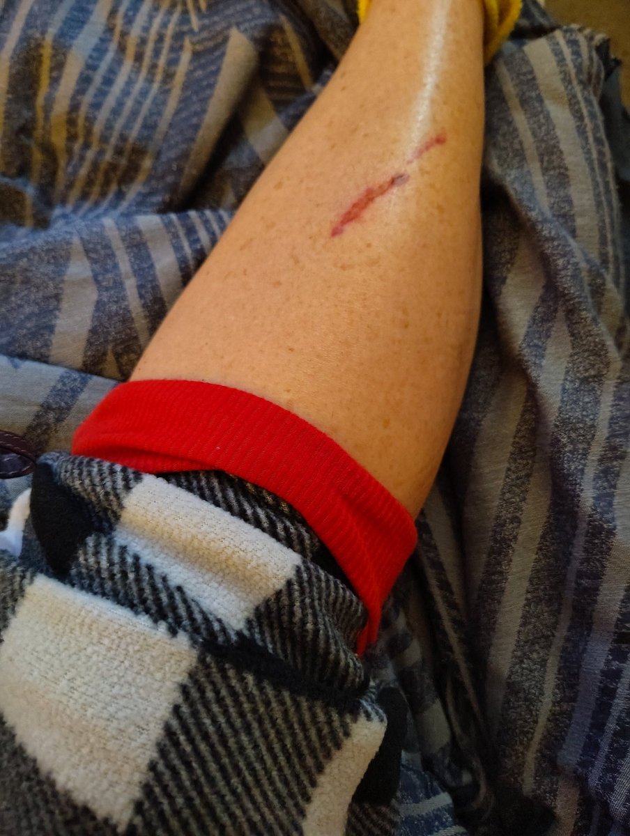 DeejHoneyDrop's tweet image. Work scars ;) #clumsy #sharpsafe #Goodtimes 🤦‍♀️🤷‍♀️🫤🩸😂 
They don't appreciate me enuff 😆😎😅