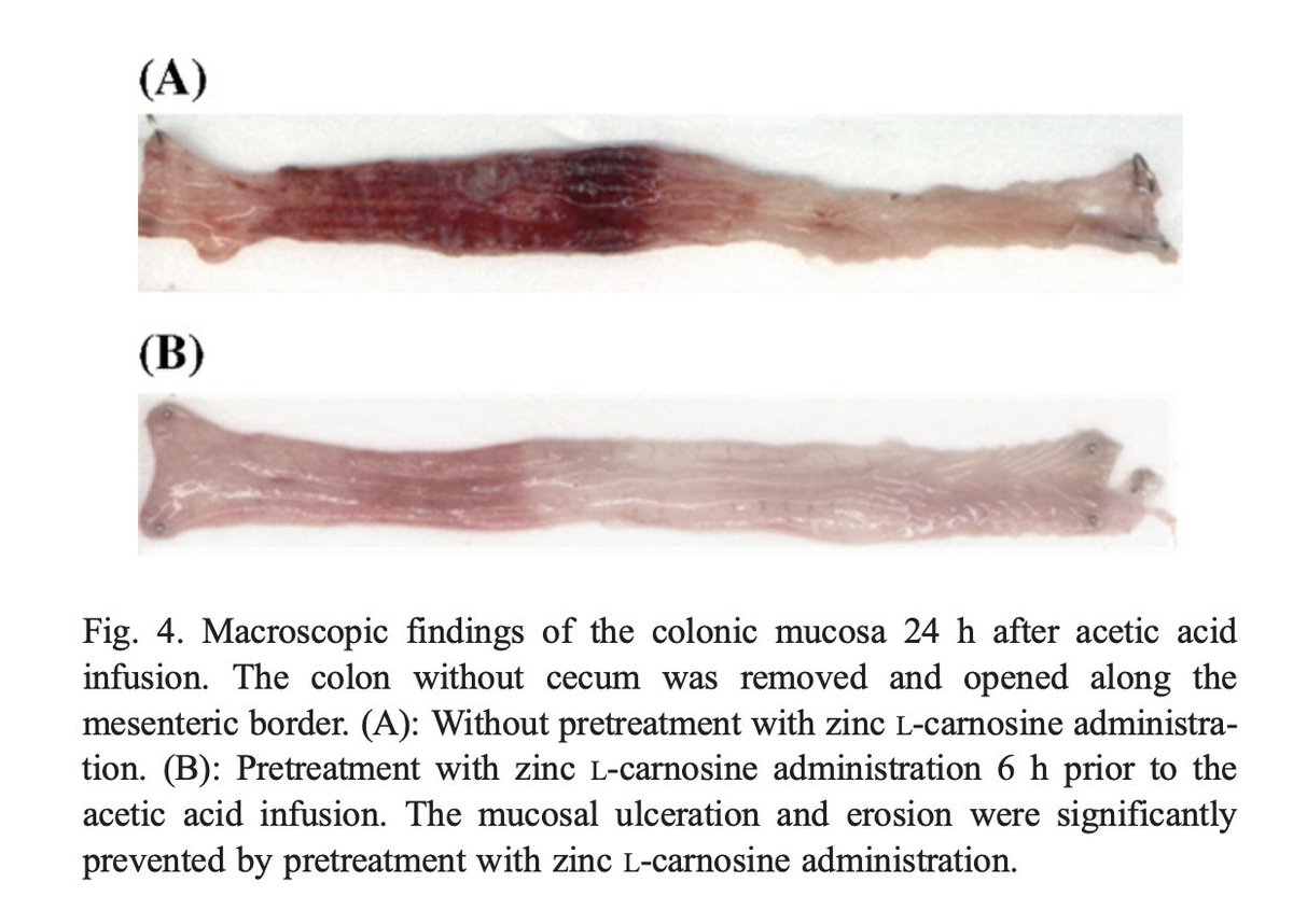 Zinc Carnosine markedly reduces gut inflammation.

Zinc suppresses NF-κB - the master nuclear driver of inflammation.

This allows the inflammation to calm and the healing to start.

One of our absolute favorites for clients.