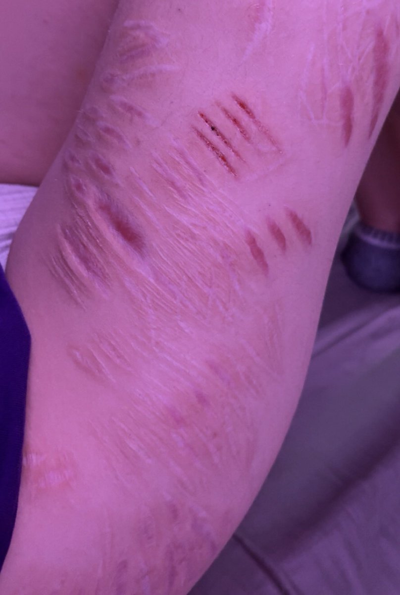 this pic rly shows all my little white scars
#shtwt #sh