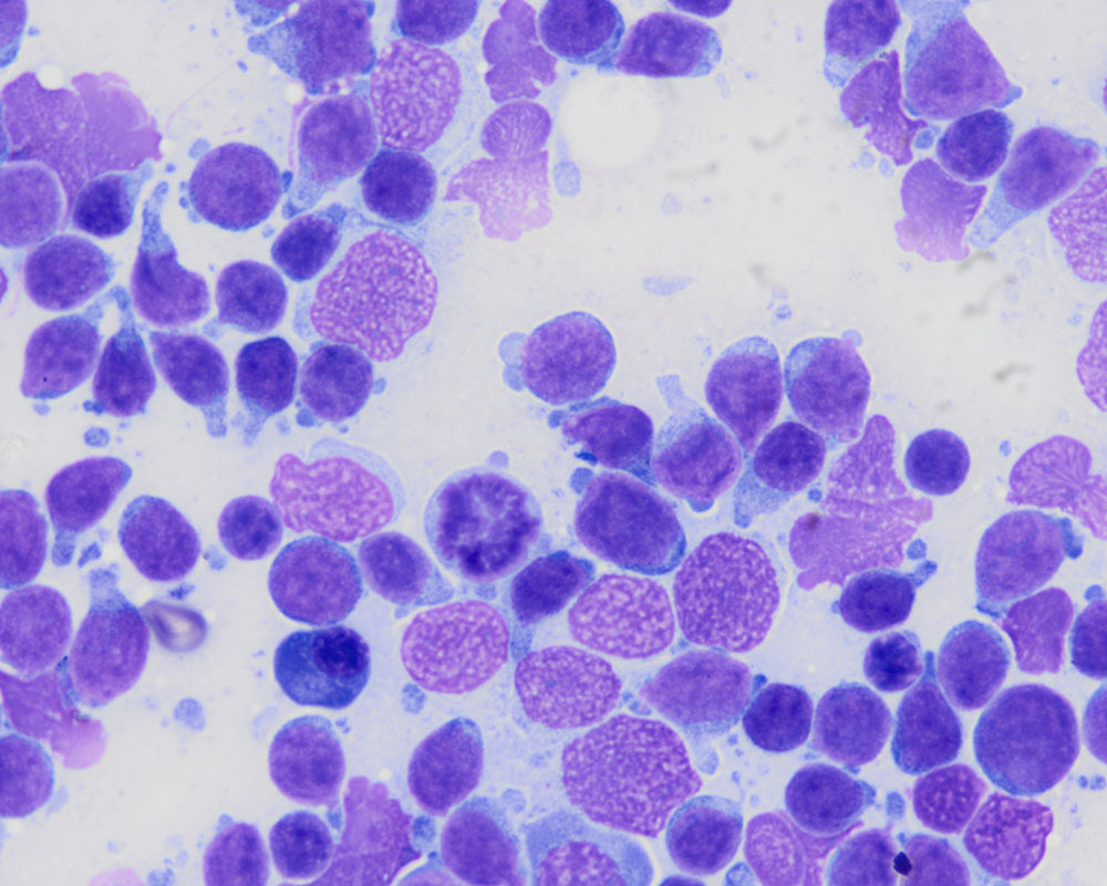 eClinPathCU's tweet photo. Our latest diagnostic challenge from our first year resident! A blood smear and lymph node aspirate from a 12 year old dog with seizures (first image: blood; second to fourth images: lymph node). Read the case at https://t.co/6UMVUVpLaI. https://t.co/TTW90pv5y9