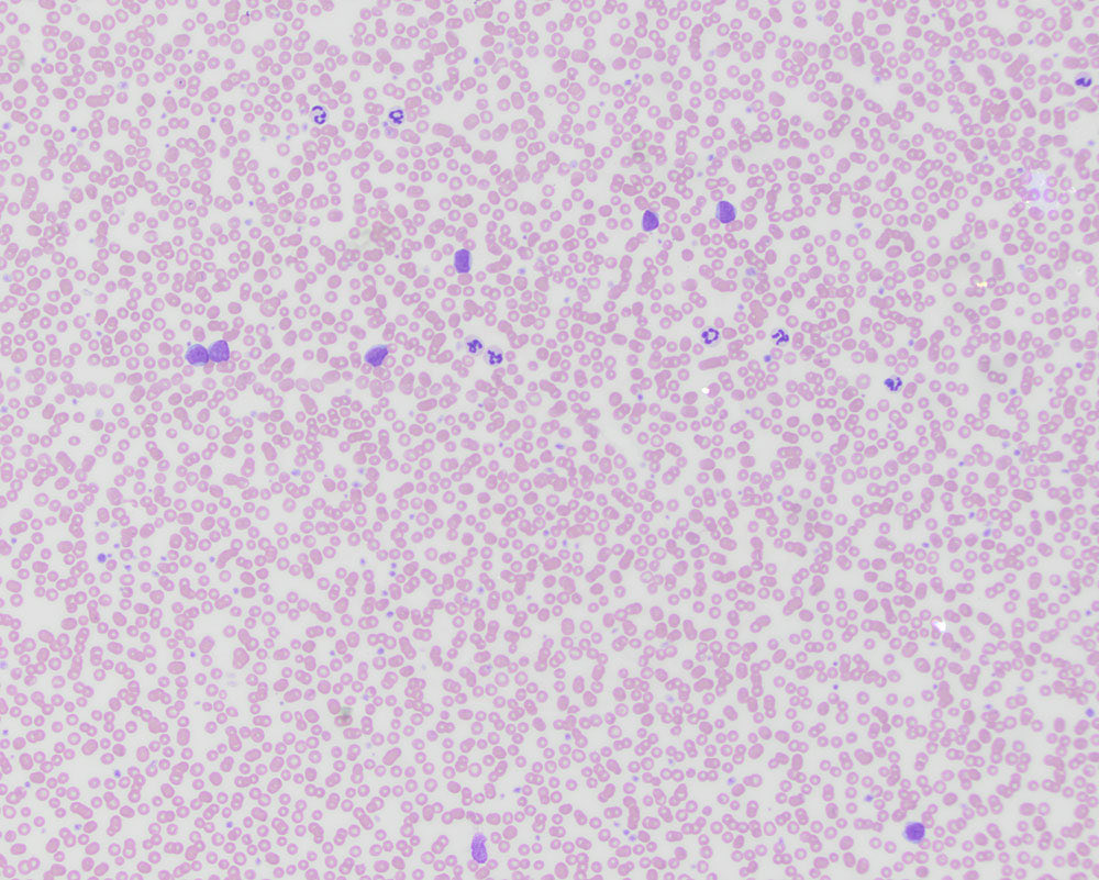 eClinPathCU's tweet photo. Our latest diagnostic challenge from our first year resident! A blood smear and lymph node aspirate from a 12 year old dog with seizures (first image: blood; second to fourth images: lymph node). Read the case at https://t.co/6UMVUVpLaI. https://t.co/TTW90pv5y9