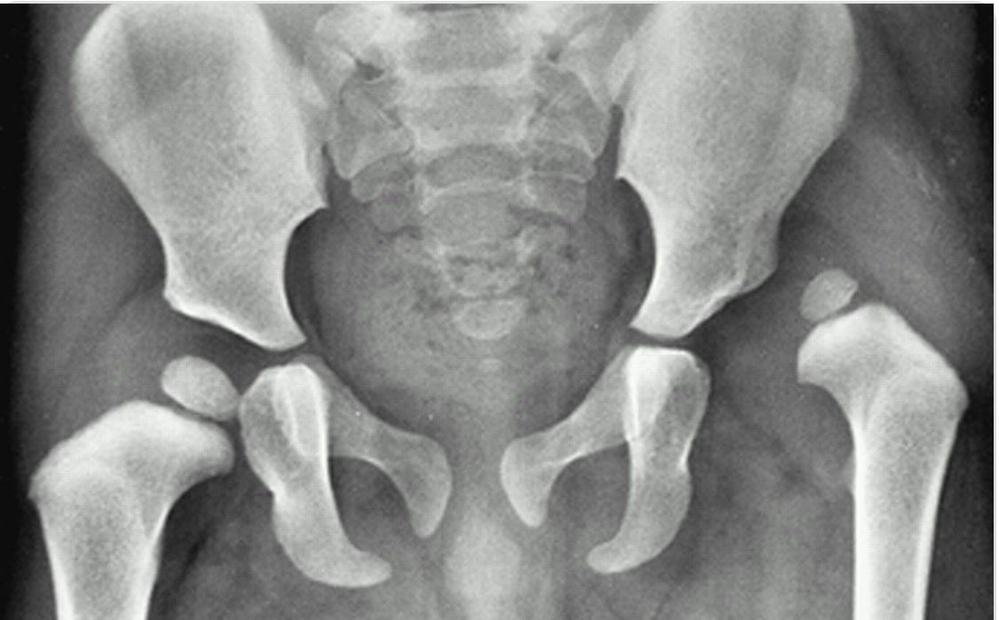 Diagnosis?
Screening tests?
Treatment?
<a href="/dr_manish_ydv/">अहिरावण</a> 
<a href="/Dr_Shiv_kumar_/">Dr. Shiv_Kumar</a> 
<a href="/SameerYogi14/">Dr Ajay yadav</a> 
<a href="/drabdulhameed07/">Dr Abdul Hameed 🩺</a> 
<a href="/DrsansariOrd/">Haji Siyamuddin ANSARI</a> 
<a href="/sadiairum990/">Dr. Sadia Irum 🇺🇸</a> 
<a href="/AnushkaMoray/">Anushka</a> 
<a href="/fzn733/">Faizan A.</a> 
<a href="/usernamee389/">Peter 🌚</a> 
<a href="/albertoortegana/">C.Alberto Ortega</a> 
<a href="/MiguelP23970914/">Antonio Arroyo, MD. Medico Cirujano.</a>