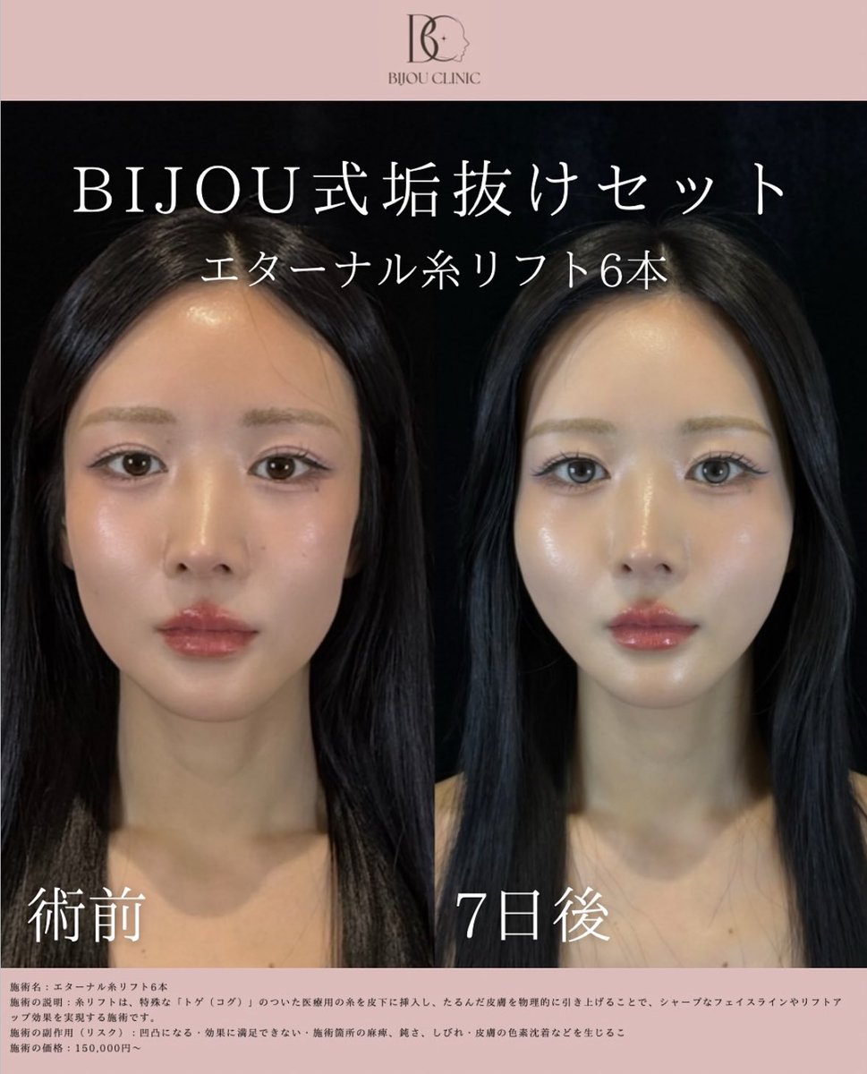 bijoclinic's tweet photo. 大人気の糸リフト🫧🤍 https://t.co/uW4xaClXta