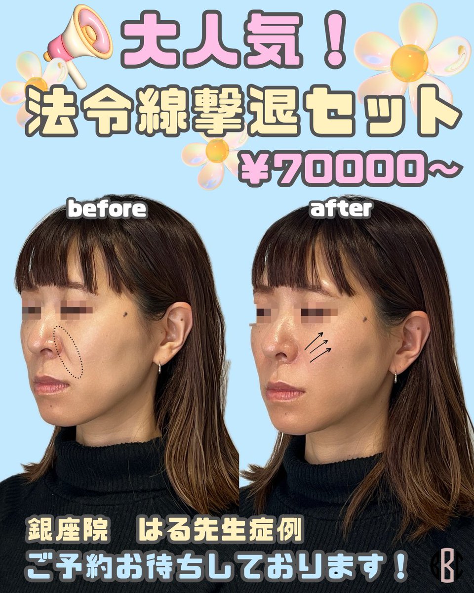 BONBONCLINIC's tweet photo. 銀座院💉はる先生　症例写真👩🏻‍⚕️✨
✔️法令線撃退セット　¥70,000〜

糸リフト✖️ヒアルロン酸で法令線を撃退‼️若々しい印象に…✨👀

今ならお得な価格にてお施術可能です🎀

ヒアル・ボトックス・カベリンも
お得なクーポン🎁LINE限定で配布中🌈

📲今すぐチェック💌

☎️03-6263-8261
LINE▶️【@bonbonclinic】で検索🔍

#銀座美容 #bonbonclinic #糸リフト #ヒアルロン酸 #ボトックス