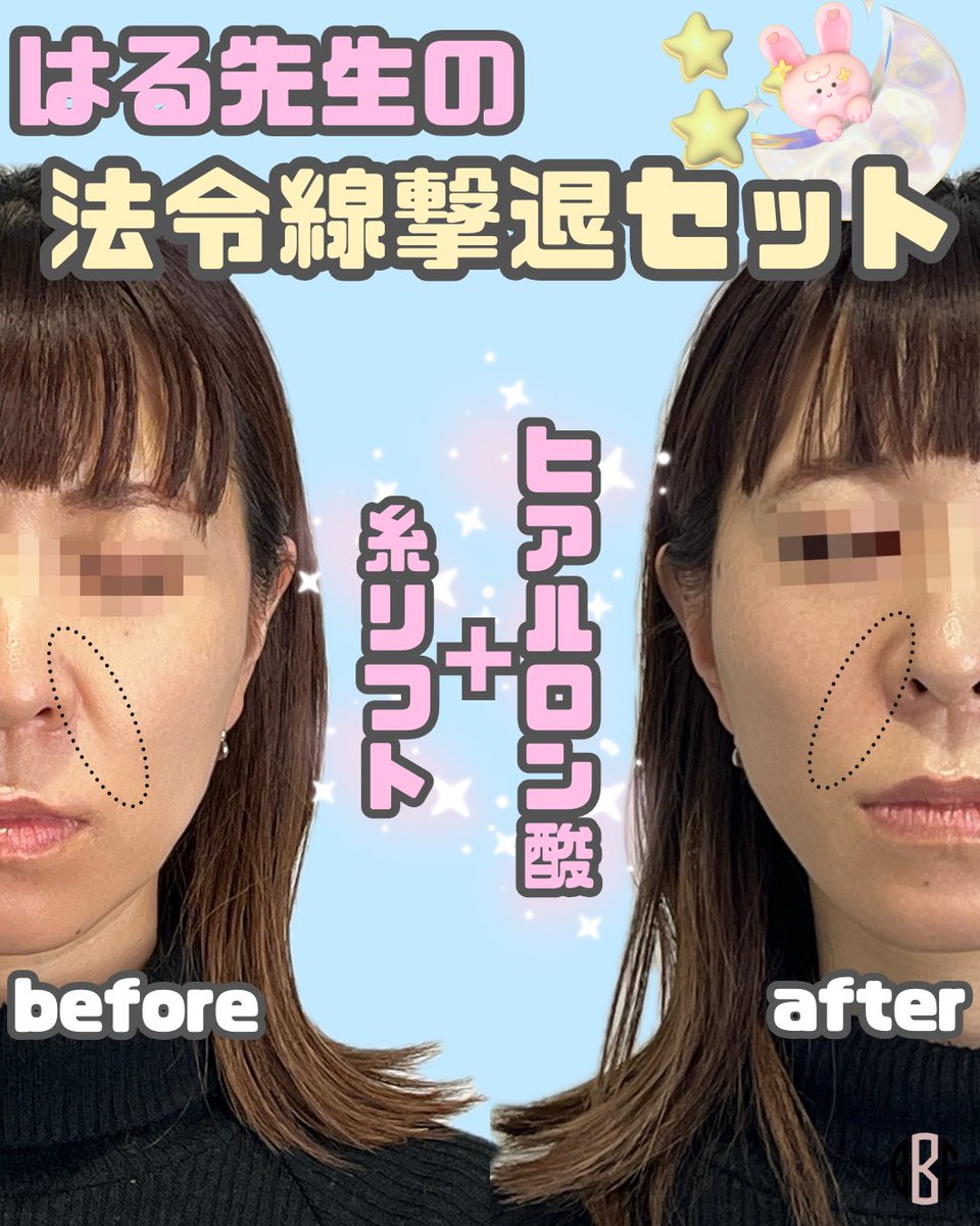 BONBONCLINIC's tweet photo. 銀座院💉はる先生　症例写真👩🏻‍⚕️✨
✔️法令線撃退セット　¥70,000〜

糸リフト✖️ヒアルロン酸で法令線を撃退‼️若々しい印象に…✨👀

今ならお得な価格にてお施術可能です🎀

ヒアル・ボトックス・カベリンも
お得なクーポン🎁LINE限定で配布中🌈

📲今すぐチェック💌

☎️03-6263-8261
LINE▶️【@bonbonclinic】で検索🔍

#銀座美容 #bonbonclinic #糸リフト #ヒアルロン酸 #ボトックス