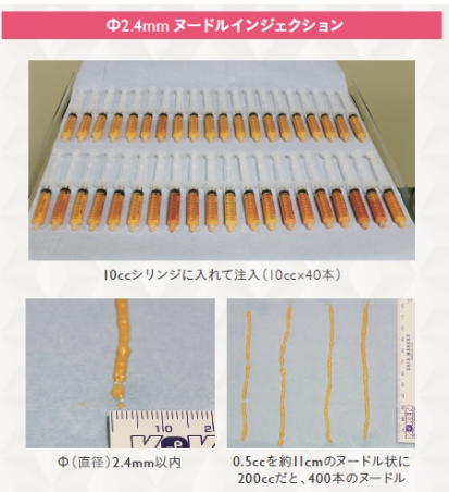 theclinicohashi's tweet photo. これが脂肪豊胸でできたしこりの実物です。
（写真①：実際のしこり）
注入された脂肪が壊死して石灰化し、こんな硬い塊になってしまう。
触ると痛い、形が崩れる…
こういう状態でご相談に来られる方がとても多いです。
（写真②：脂肪豊胸後にできたしこりによる変形）

原因は、
注入した脂肪に血流が届かず細胞が死んでしまった。
特に塊で大量に入れると、脂肪は生き残りません。

防ぐ方法は1つです。
細く、満遍なく、層ごとに分散して注入すること。

当院では2.4mmヌードルインジェクション法で、
直径約2mmの麺状脂肪を全層に丁寧に広げて注入しています。

（写真③：シリンジ列）

これで血流が届きやすくなり、
しこりのリスクを大幅に下げられます。

「脂肪豊胸＝しこりは付き物」と説明されることもありますが、適切な技術であれば防ぐことができます。

当院で脂肪豊胸を受けた方の5年後、MRIでしこりゼロの状態です。

（写真④：術前→5年後の比較）

触ると硬い気がする、形が変わってきた気がする…
そんな違和感があれば、まずはエコー検査をおすすめします。
#脂肪豊胸 #しこり予防 #THECLINIC