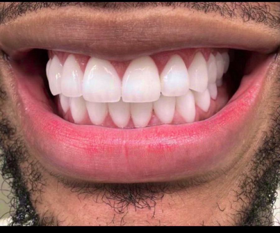 How did you brush your teeth 

A- before meal ready
B- after meal ready
C- after eating breakfast