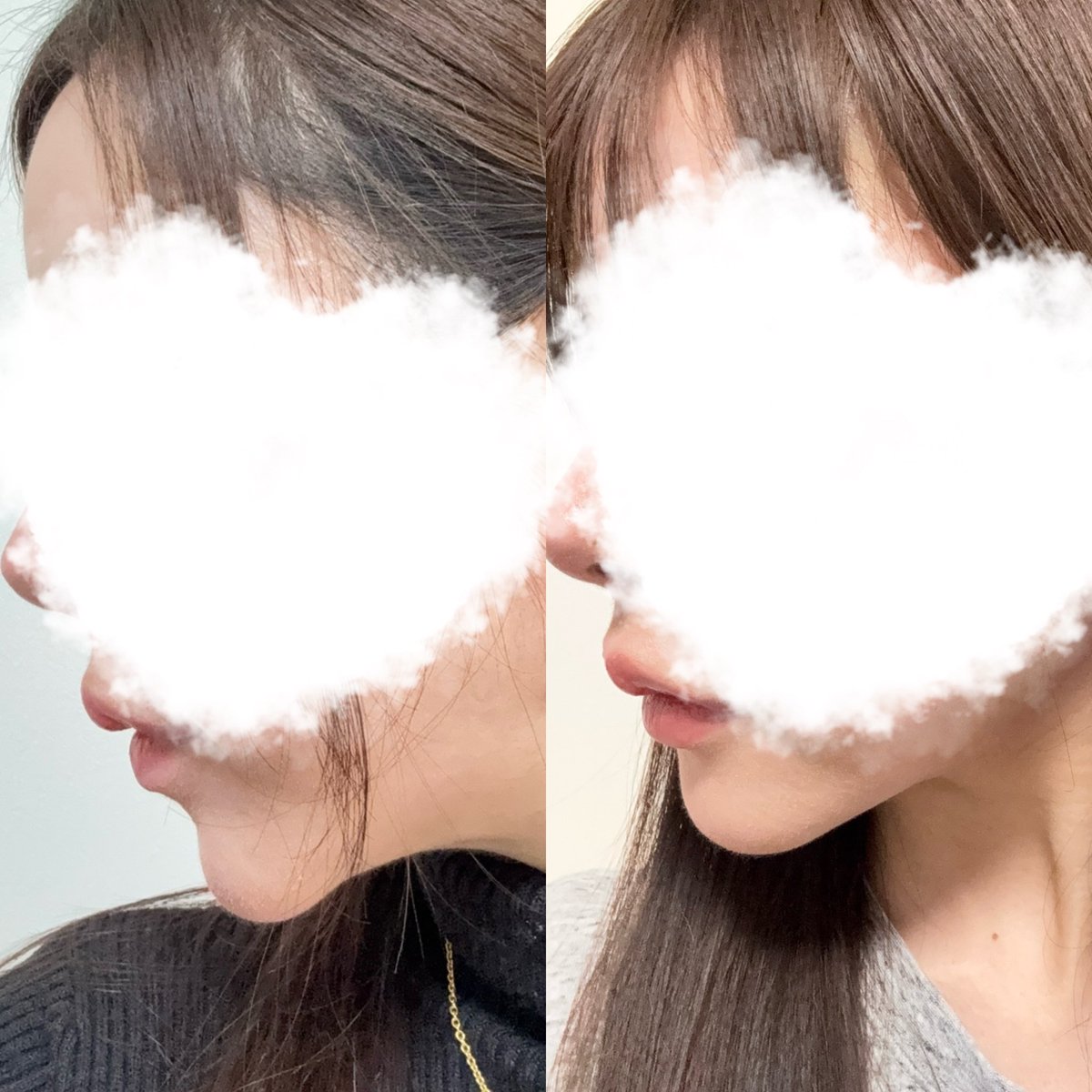 i_erre's tweet photo. リチャム美容外科さんで
魔女顎手術してもうすぐで1ヶ月
顎短くなったかな
横から見た時の垂れ下がってるのが
改善されたと思う！
内側からと外側両方からアプローチしてもいました！

#魔女顎手術 https://t.co/dOC6VpMXGX