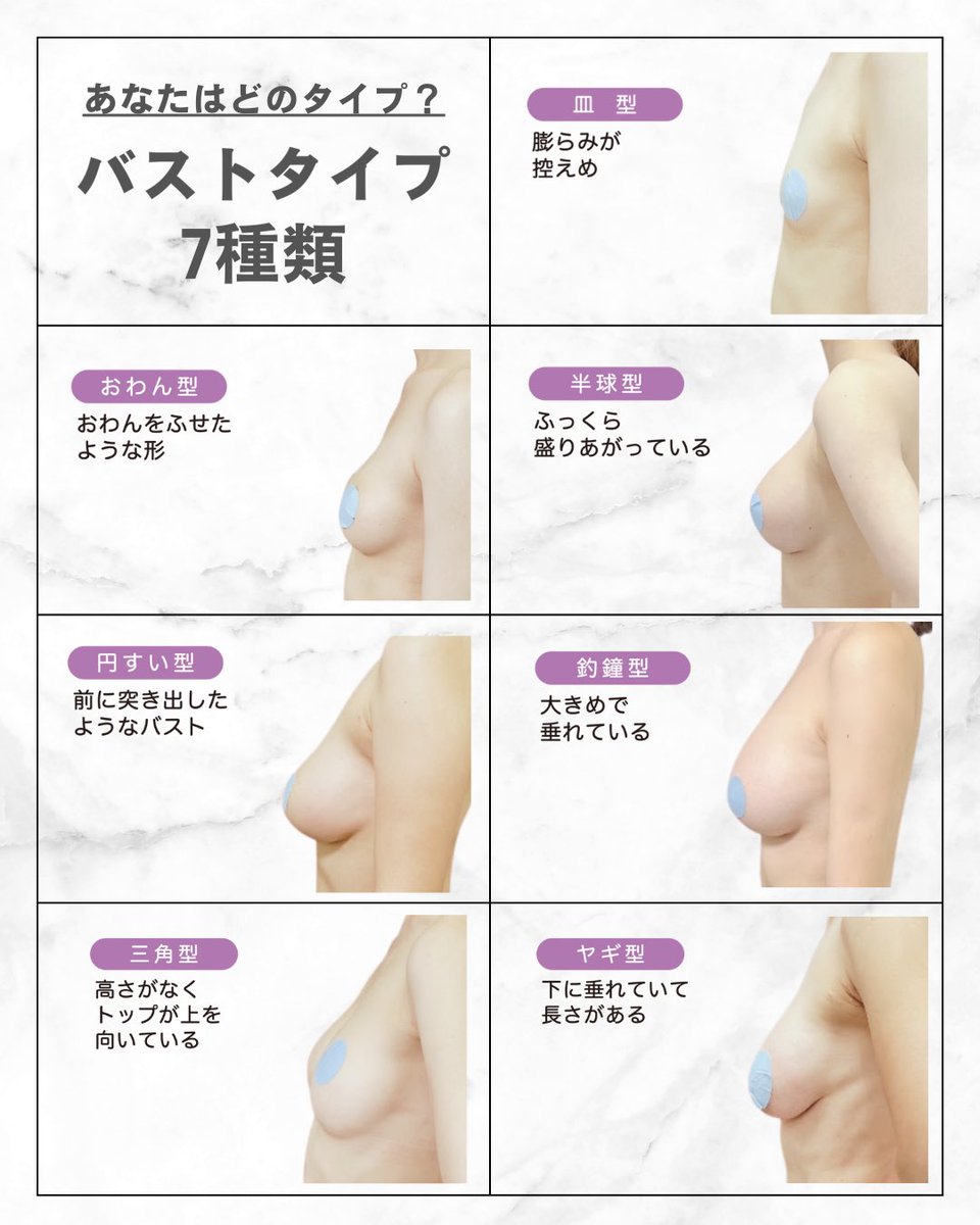 drayakom's tweet photo. 【バストタイプ7種類】
⭐️皿型
いわゆる"まな板"タイプ。バージスラインがなく、トップとアンダーの差もほぼないタイプ。一回で大きくするならシリコン適応。
⭐️お椀型
控えめだけどきれいなタイプ。B-Cカップでもこのタイプであれば美乳。
⭐️半球型
別名ラウンド型。豊胸で目指す形No.1。
デコルテからふっくら盛り上がっている。
⭐️円錐型
突出感が少しある。
⭐️釣鐘型
円錐型より少しトップが下がった形。
いわゆる雫型バストはこれ。
⭐️三角型
デコルテ部分が削げている形。脂肪豊胸で改善可能
⭐️ヤギ型
授乳などでかなり削げてしまっている。乳房吊り上げ術が適応なこともある。