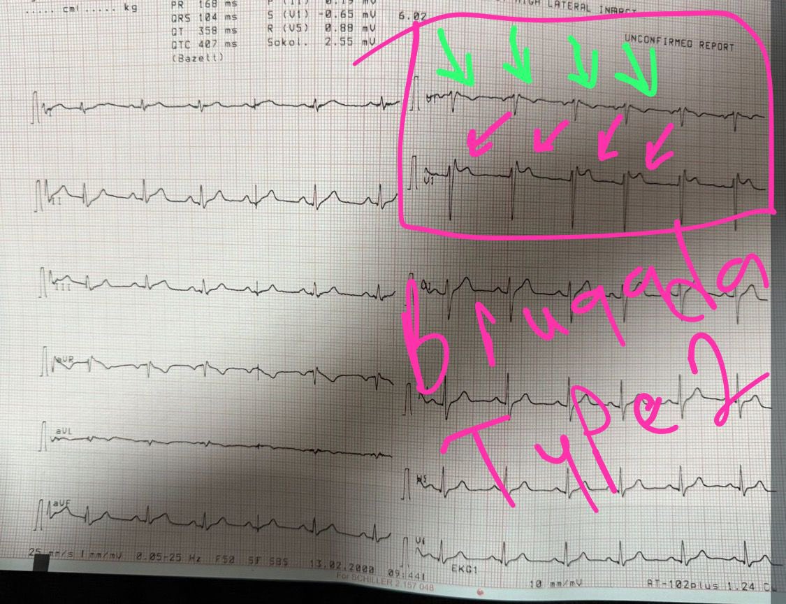 Brugada paterni tip 2. V2'de, merkezde eyer şeklinde bir çöküntü ile birlikte ST yükselmesi gözlenir. Eyer sırtı şeklinde ST yükselmesi vardır. J noktası en az 2 mm, ST segmenti ise en az 1 mm yükselmiştir. T dalgası pozitif veya bifazik olabilir.