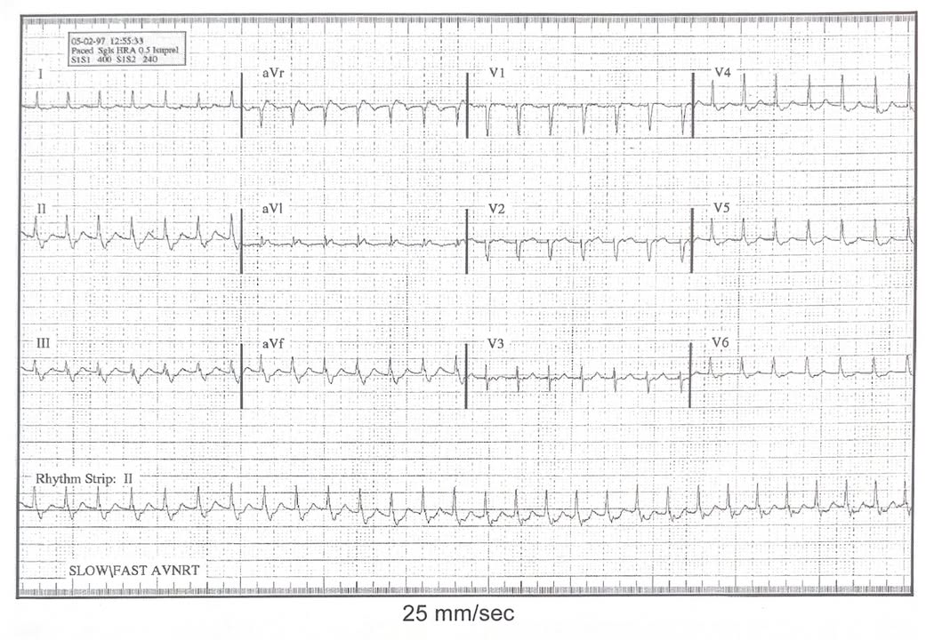 ChartAcademy's tweet image. 🫀 #SundaySchool

👨‍🏫 Questions
1. Rhythm?
2. Rate?
3. QRS narrow or wide?
4. R-R regular?
5. P waves visible?

🤓 Are you reading the H&amp;amp;P before very case?

🔗 Link in bio

#EPeeps #VivaEP #CHARTepPro #CHARTcoach #CaseStudy #Electrophysiology #ECG #EKG #HeartRhythm