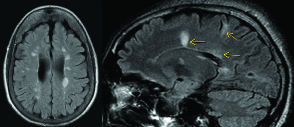 PracticalNeuro's tweet image. MRI is central to #MultipleSclerosis diagnosis. 

A review article by Drs. Elfasi and Fagundo highlights radiologic #biomarkers in the 2024 #McDonald criteria—including the central vein sign, paramagnetic rim lesions, cortical lesions, and optic nerve imaging.