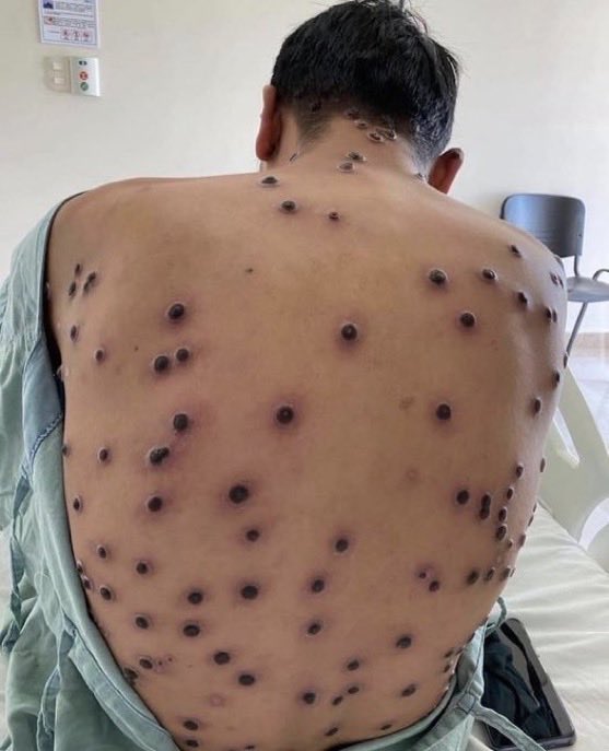 MCK_Kaif's tweet image. Whoa 😎 now it’s Brazil 🇧🇷?

🚨 Breaking News | Brazil has recorded 48 cases of mpox in the first few months of 2026. #Virus