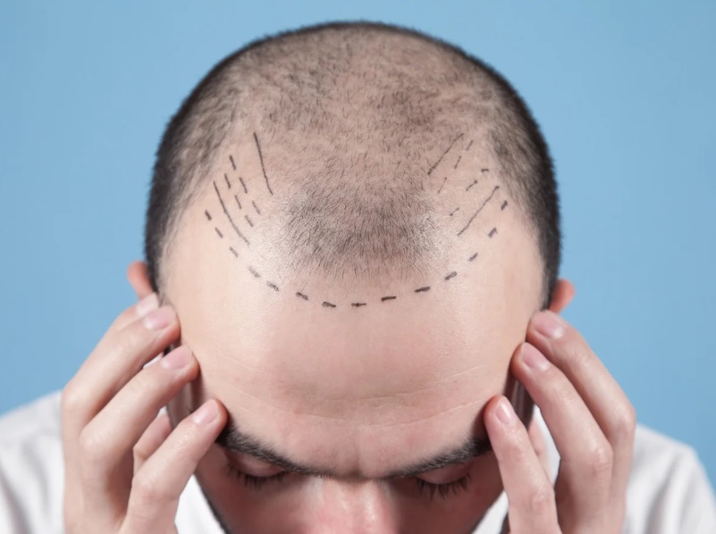 Hair Loss News tweet media