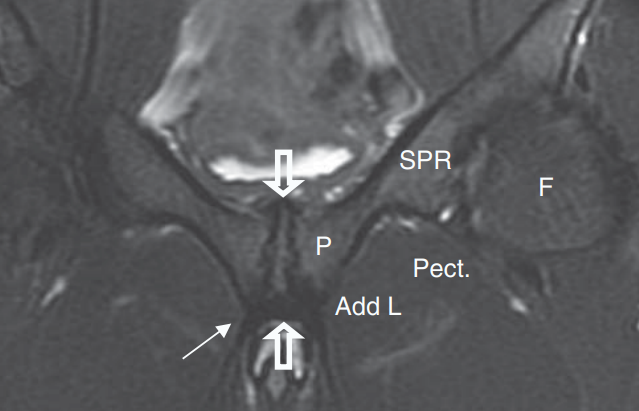 SportsMedReview's tweet image. Dr. Rubin reviews osteitis pubis!
--
Read: sportsmedreview.com/blog/osteitis-…
--
#MedicalEducation #MedEd #Physio #ATC #Orthopedics #SportsMedicine #PhysicalTherapy #AthleticTraining #Rehab #InjuryPrevention #SportsInjury #SportsRehab #PhysioTherapy #FOAMed