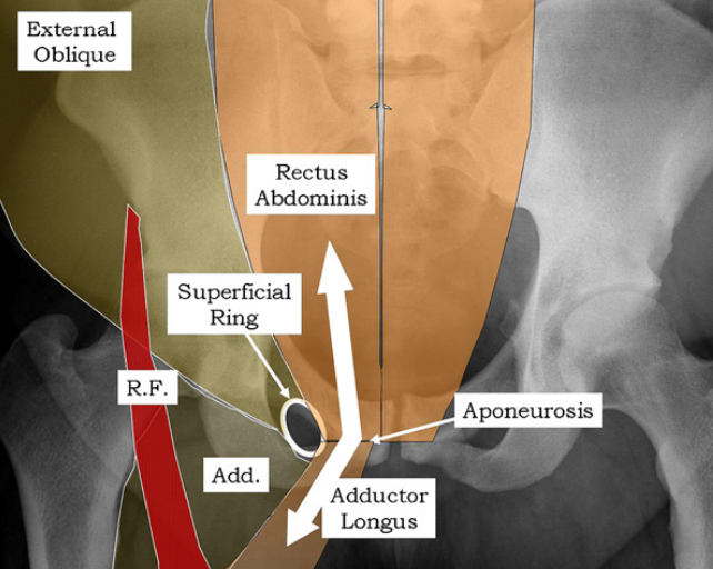 SportsMedReview's tweet image. Dr. Rubin reviews osteitis pubis!
--
Read: sportsmedreview.com/blog/osteitis-…
--
#MedicalEducation #MedEd #Physio #ATC #Orthopedics #SportsMedicine #PhysicalTherapy #AthleticTraining #Rehab #InjuryPrevention #SportsInjury #SportsRehab #PhysioTherapy #FOAMed