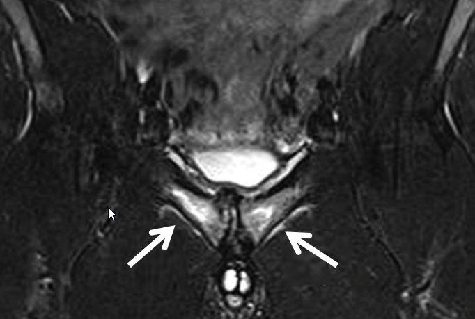 SportsMedReview's tweet image. Dr. Rubin reviews osteitis pubis!
--
Read: sportsmedreview.com/blog/osteitis-…
--
#MedicalEducation #MedEd #Physio #ATC #Orthopedics #SportsMedicine #PhysicalTherapy #AthleticTraining #Rehab #InjuryPrevention #SportsInjury #SportsRehab #PhysioTherapy #FOAMed