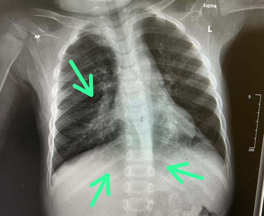 2 years  old boy  with failure to thrive,chronic cough and diarrhea and very unpleasant breath smell. spot the diagnosis?
<a href="/IhabFathiSulima/">Dr Ihab Suliman</a> #MEDHTM <a href="/hemo_shk/">Dr.Haitham Hamoud | د.هيثم</a> @Jkbjb1 #TooCloseToDiagnose <a href="/MoarSahitoPTI/">Dr. Muhammad Moor</a>
<a href="/MRCEMPREP/">Daily Dose of Medicine</a>
<a href="/neoskinhealer/">Dr. ISHWAR N RATHORE MD</a> <a href="/DrBassemKurdi/">د. باسم | طبيب أطفال</a>
@mohammadalmo
