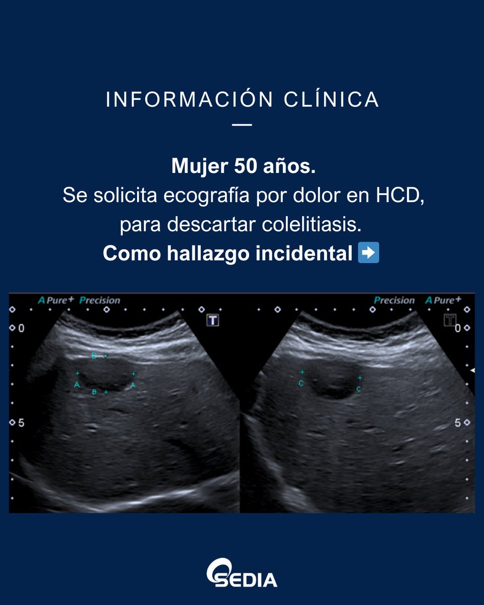 sediabdomen's tweet photo. 🩻 Caso del Mes SEDIA (febrero)
Participa y opta a una inscripción gratuita al Congreso SEDIA 2026.

Contesta a través de nuestra web
https://t.co/gkym0xiCK6

Caso realizado por el Dr. José Vizuete del Río (H. U. Dr. Peset,Valencia).

#SEDIA #Radiología #CasoDelMes #CongresoSEDIA https://t.co/0lOF8DzUj4