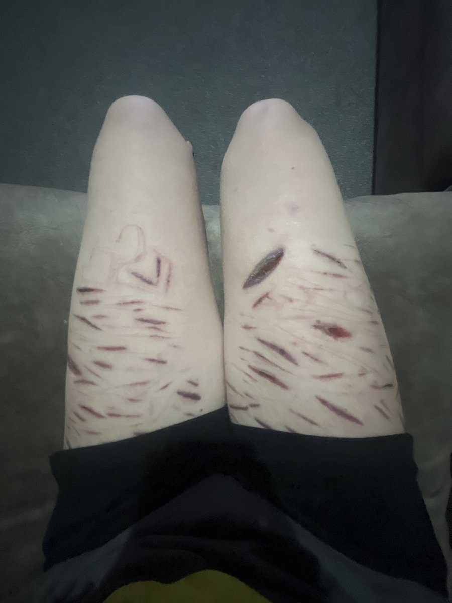 Back when these shorts covered my scars