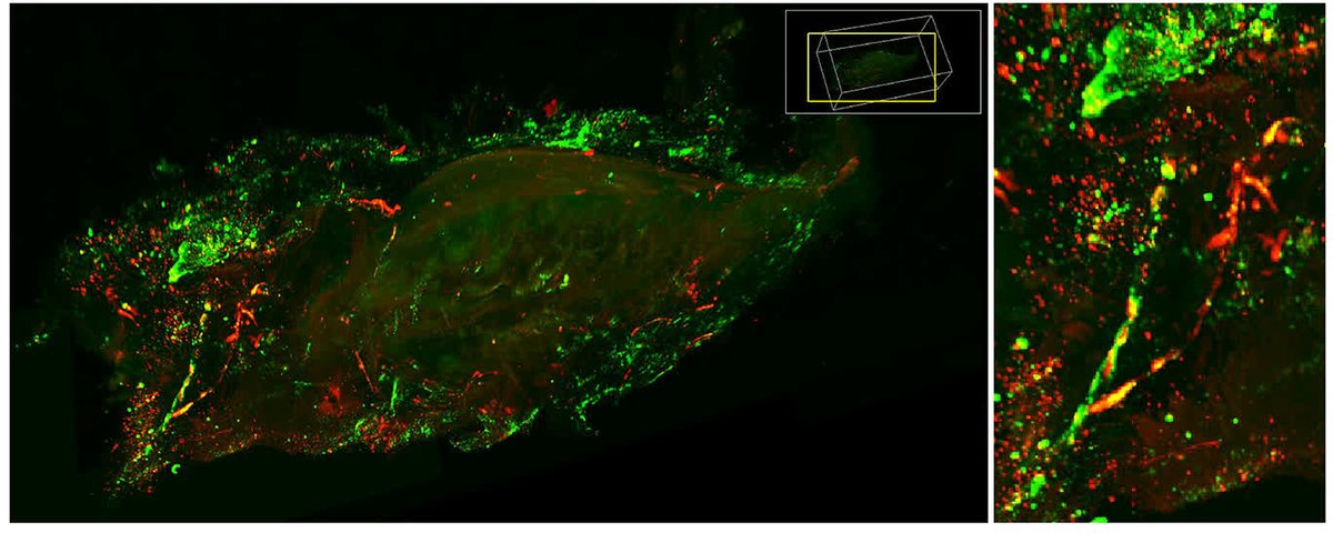 CircRes's tweet photo. Sun & colleagues found that human blood contains a type of stem cell (#CD34+) that can become #fibroblast and contribute to #fibrosis in the heart, which can influence function. Learn more at https://t.co/tQiy2Gn7bv
@QingboX https://t.co/5IuBfINOSL