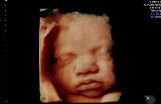 This is what an unborn baby looks like at 24 weeks.

Every unborn baby is a unique human being with a right to life.

We must end abortion.