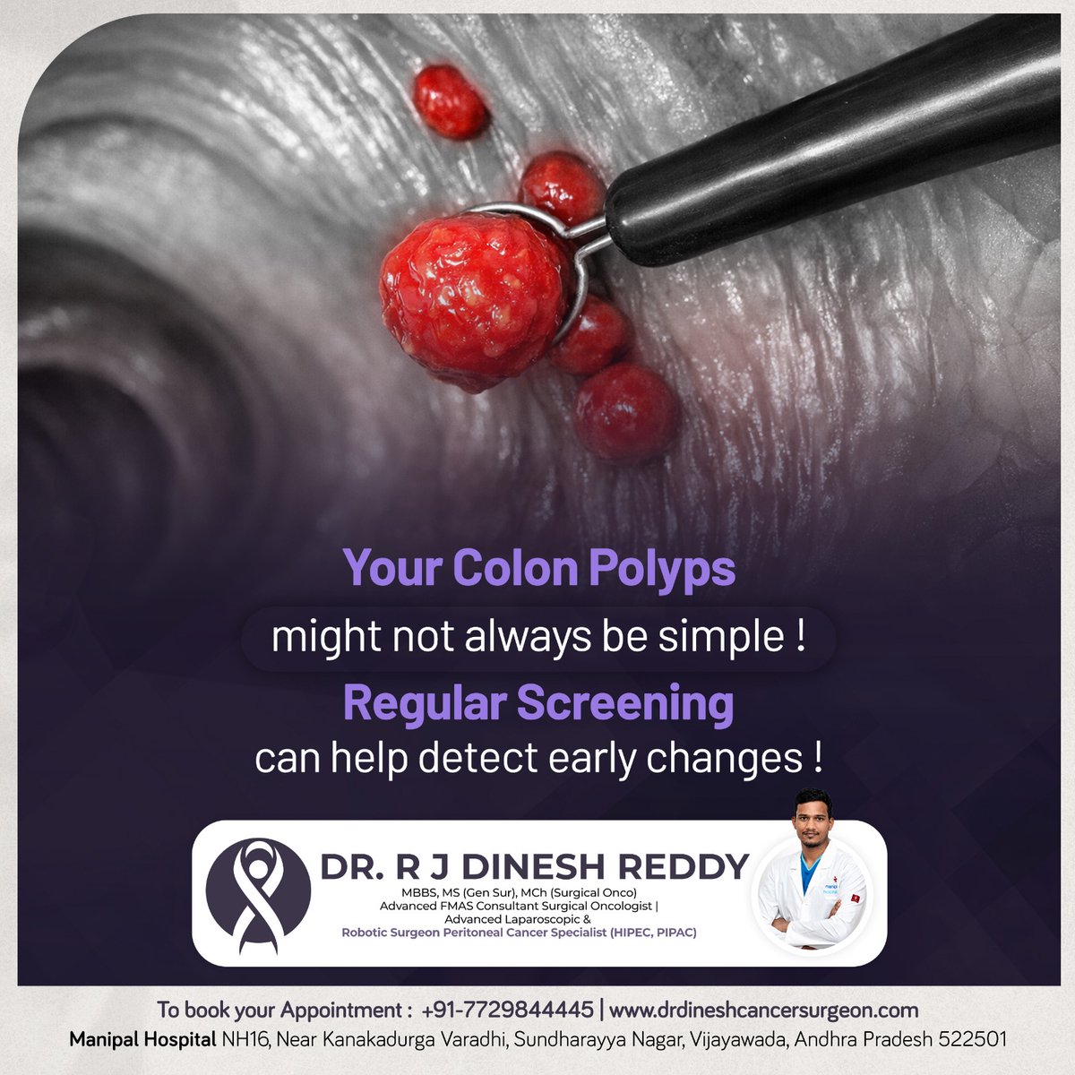 drdinesh_reddy's tweet image. Book an appointment: +91 77298 44445
Visit: drdineshcancersurgeon.com

#ColonHealth #ColonPolyps #CancerScreening  #DrDineshReddy #SurgicalOncologist #VijayawadaDoctors #Vijayawada #HealthCheckup #HealthAwareness #CancerPrevention #EarlyDetectionSavesLives #HealthcareIndia