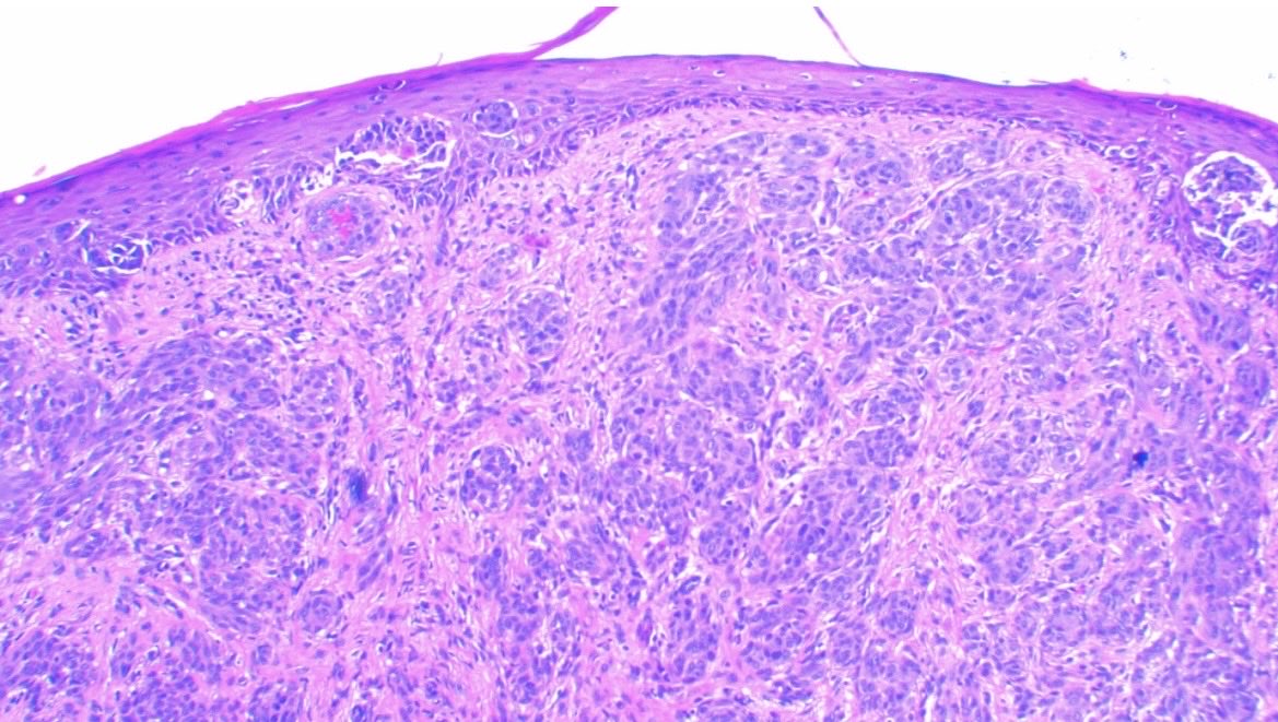 JCandidoXavier's tweet image. Spitz nevus with ALK expression

Male, 12 y/o
Polypoid compound lesion
Plexiform/fascicular growth of amelanotic spindle and epithelioid cells
P16 +
Melan (magenta) and ki-67 with low index

HE, p16, ALK

#path #dermpath #dermatology