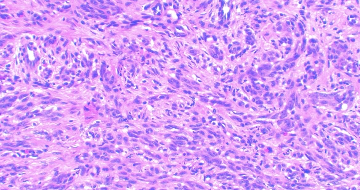 JCandidoXavier's tweet image. Spitz nevus with ALK expression

Male, 12 y/o
Polypoid compound lesion
Plexiform/fascicular growth of amelanotic spindle and epithelioid cells
P16 +
Melan (magenta) and ki-67 with low index

HE, p16, ALK

#path #dermpath #dermatology