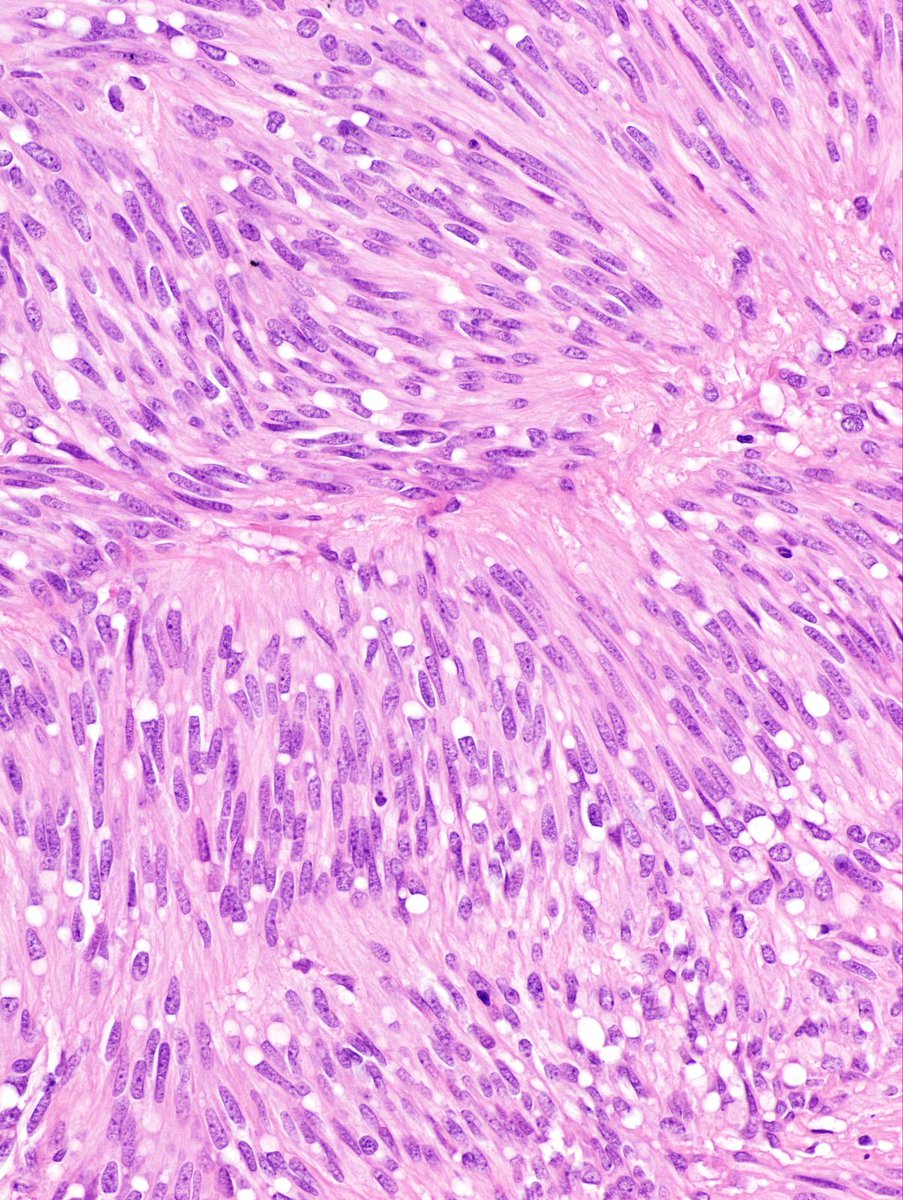 DrCycloPath's tweet photo. #PathQuiz 🔬
A) Gastrointestinal stromal tumor
B) Leiomyoma
C) Schwannoma
D) Inflammatory fibroid polyp

#Pathology #GIPath 
Clue in caption 🧐 https://t.co/dMHfuLDPZ6