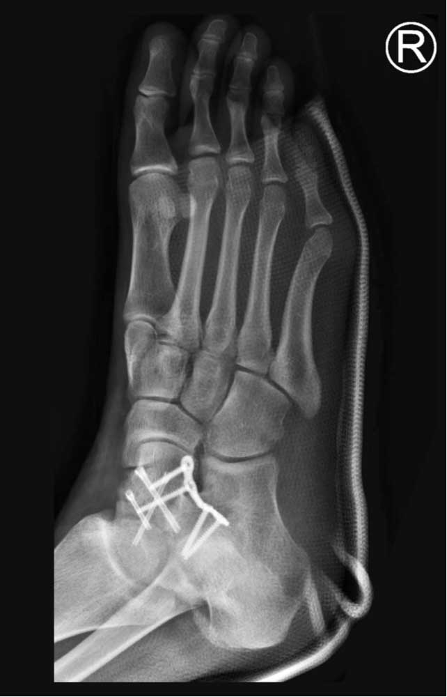 sportsfootankle's tweet image. A #talarneck #fracture (broken talus) can cause:
• Severe foot/ankle pain
 • Swelling &amp;amp; tenderness
 • Inability to bear weight
 • Possible deformity or bone protrusion
medilink.us/5ezi #fracturedtalus #brokenankle