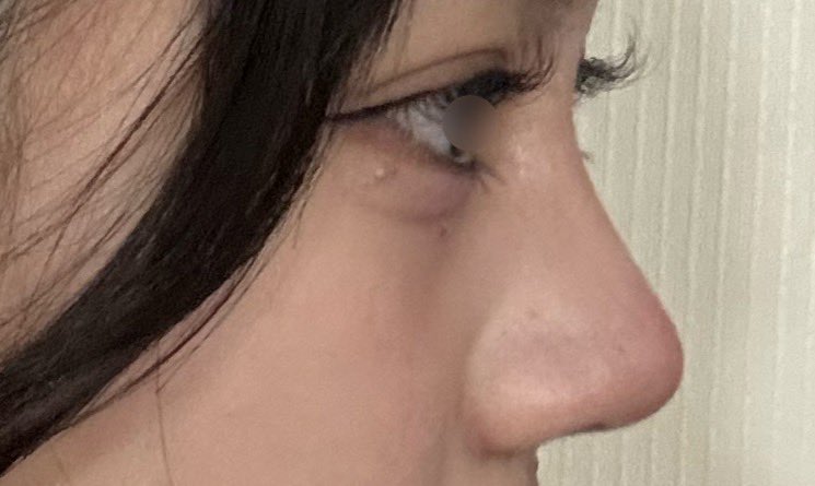 cherry_0555's tweet photo. セギム美容外科さんで二重切開と鼻フルをして3ヶ月が経ちました！執刀医はユン･テホ先生です！
コンプレックスだった目と鼻が綺麗になって嬉しいです！✨️

1枚目 before 
2枚目〜4枚目 after https://t.co/QnPHBLmcEf