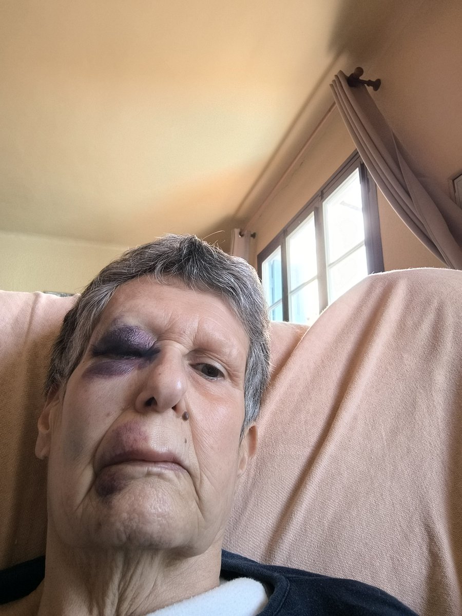 Les copains, copines, je suis tombée. J'ai très mal. Veuillez m'excuser si je ne suis plus présente sur X. Bisousss 😘 😘 😘 😘 😘