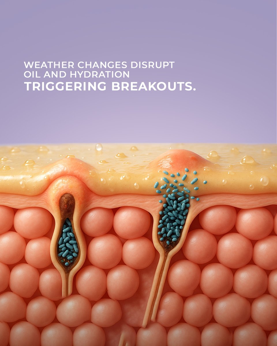 AcnestarGel's tweet image. Your skin reacts to the seasons faster than you realise.
Changes in weather can throw off its balance, leading to dryness, breakouts, or sensitivity.
Understanding these shifts helps you care for it better.

#AcneStar #AcneStarGel #AcneStarFacewash #DailySkincare