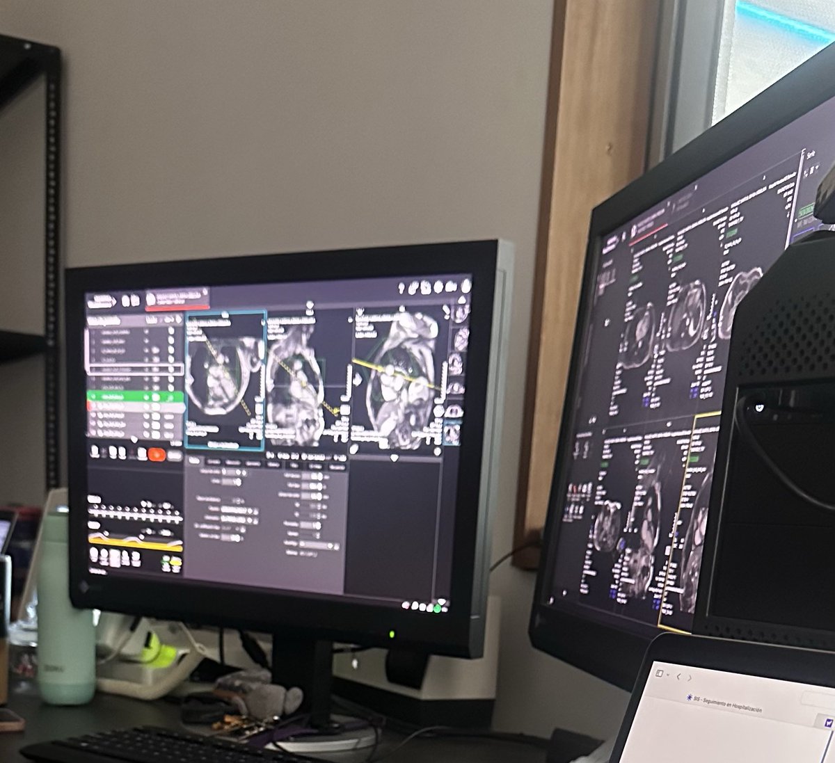 ImerAlb's tweet photo. Resonancia magnética cardíaca en pacientes con aneurisma por cardiopatía chagásica 🫀🫰🏻#science #Cardiology https://t.co/OV5vFm6iOc