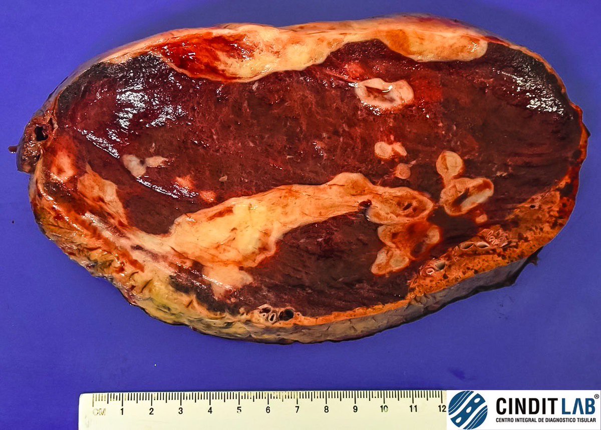 md_castaneda23's tweet photo. El hemangioma hepático es el tumor benigno más común del hígado.
Histopatológicamente, se caracteriza por ser una lesión de origen vascular bien delimitada pero no encapsulada.
#cinditlab https://t.co/PbonH4L7ET