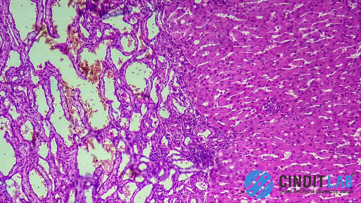 md_castaneda23's tweet photo. El hemangioma hepático es el tumor benigno más común del hígado.
Histopatológicamente, se caracteriza por ser una lesión de origen vascular bien delimitada pero no encapsulada.
#cinditlab https://t.co/PbonH4L7ET