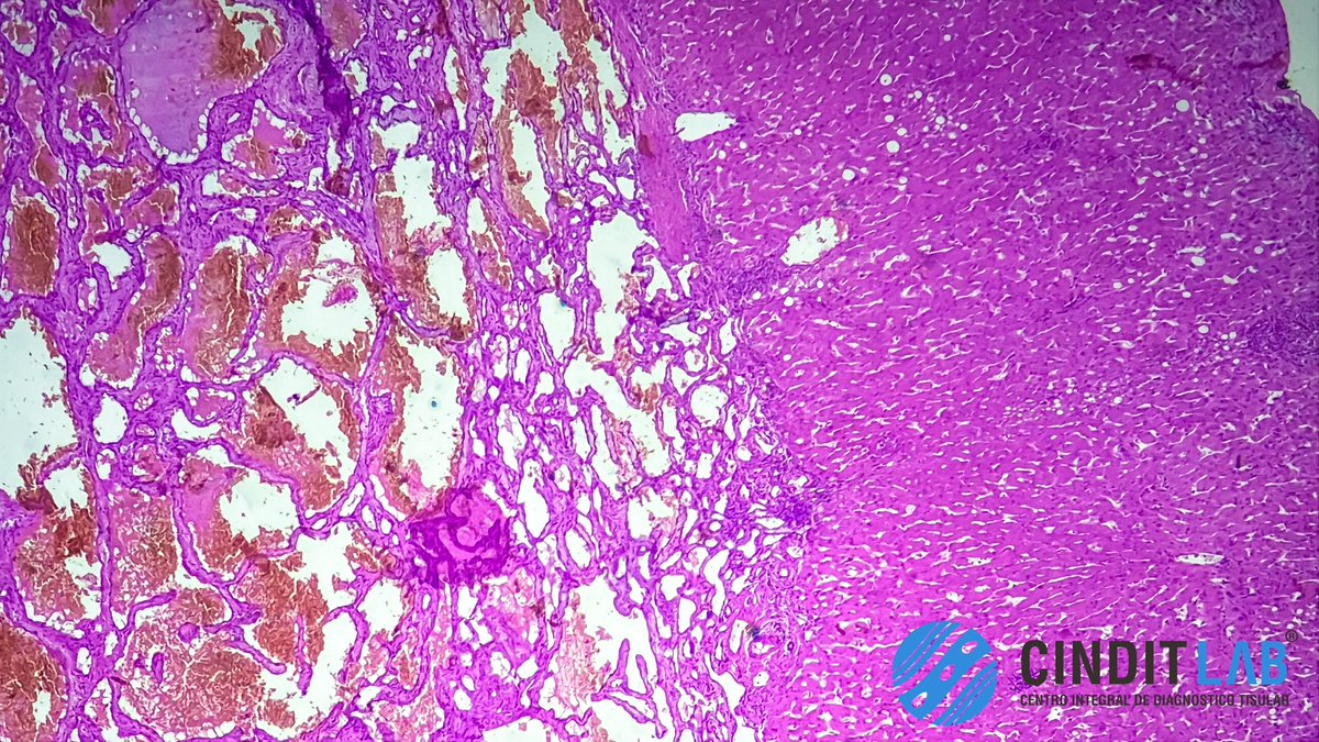 md_castaneda23's tweet photo. El hemangioma hepático es el tumor benigno más común del hígado.
Histopatológicamente, se caracteriza por ser una lesión de origen vascular bien delimitada pero no encapsulada.
#cinditlab https://t.co/PbonH4L7ET