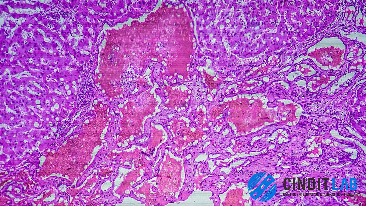 md_castaneda23's tweet photo. El hemangioma hepático es el tumor benigno más común del hígado.
Histopatológicamente, se caracteriza por ser una lesión de origen vascular bien delimitada pero no encapsulada.
#cinditlab https://t.co/PbonH4L7ET