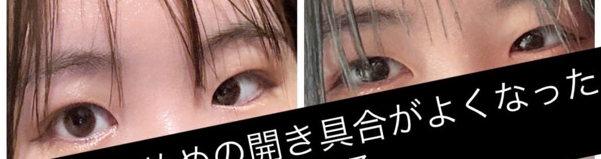 172_sn's tweet photo. instar整形外科(@instarjp )さんにて
額挙上,ボトックスをして1ヶ月が経ちました。
目の開きが良くなってきました🌸
二重のラインも復活してきたのでよかったです😿 https://t.co/eRjczK5Fjv