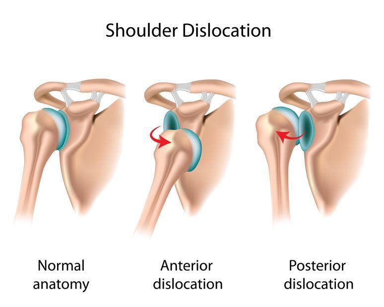 DrJeffBerg's tweet photo. Shoulder Instability - Anatomy & Causes (Video) - Jeffrey H. Berg, M.D. https://t.co/3shtRq7Z1l #ShoulderDislocation #ShoulderInstability https://t.co/N2v50EKmk1