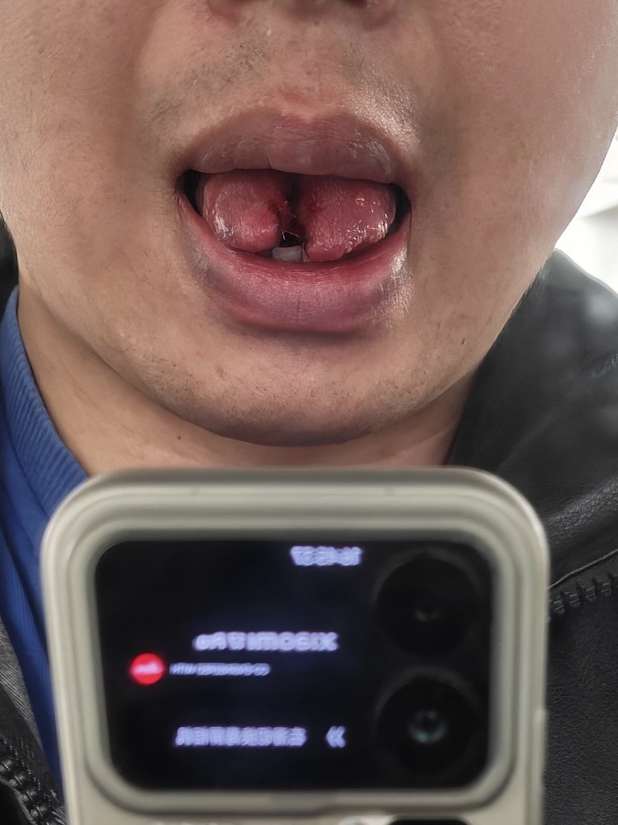 acoolda's tweet photo. tongue split.分舌的第一天，舌头没什么感觉。 https://t.co/yt14CxyDD0