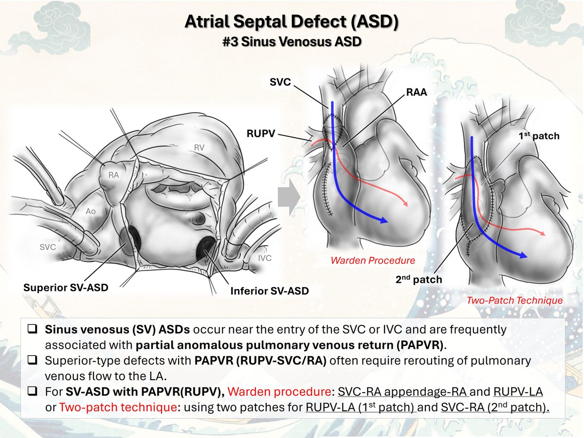 WithAScalpel's tweet photo. Atrial Septal Defect (ASD): Four Types

👉Primum ASD: Low ASD near the AV valves, within the AVSD spectrum.
👉Secondum ASD: Fossa ovalis defect and the most common ASD type.
👉Sinus venosus ASD: Venous inflow defect near the SVC/IVC, often with PAPVR.
👉Coronary sinus ASD: An unroofed coronary sinus, often associated with LSVC.