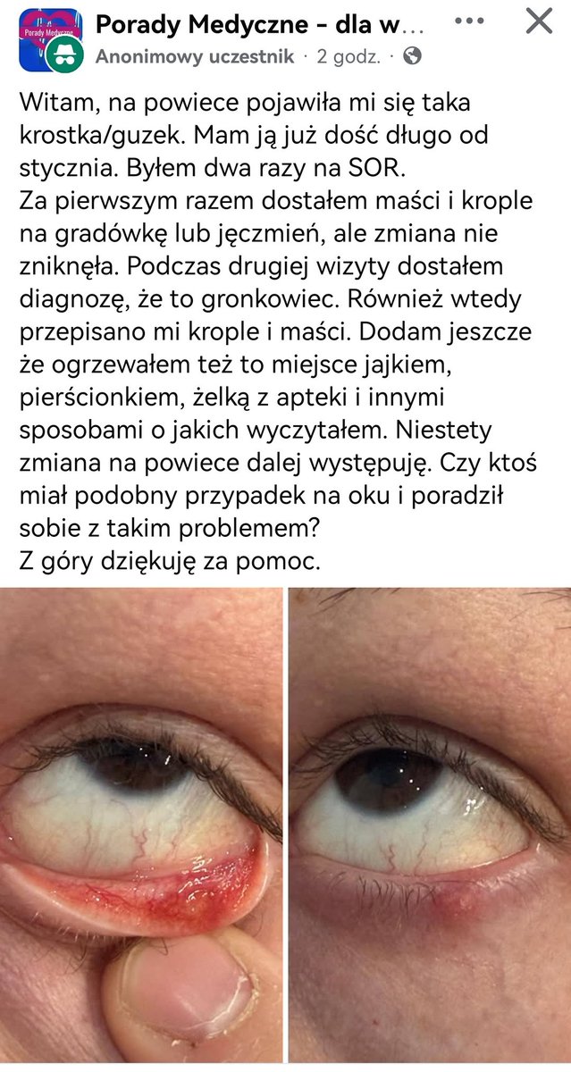 Chłop z jeczmieniem na oku był 2 razy na sorze no kurwa xdddd