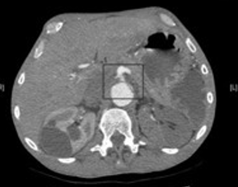 DukeAortic's tweet photo. 🧠@DukeAortic Case of the Week

Which underlying pathologic process best explains this angiographic finding?
Watch the visceral vessels carefully

🔍 Case follow-up — “Floating viscera” sign

This angiographic finding is called the "Floating Viscera" sign, indicative of dynamic visceral malperfusion.

The superior mesenteric and celiac artery opacify, but there is no visible continuity with the aorta.

Why? In aortic dissection, the true lumen can be completely compressed by the false lumen, leaving the visceral vessels appearing isolated—or "floating"—on angiography.

Recognizing this sign in aortic dissection is critical, as visceral malperfusion carries substantial mortality (34.3%).

#aortaed #AorticSurgery
Curious to hear how we treat aortic dissection with malperfusion? Follow our next post.

@DukeCTSurgery @DukeHeartCenter @DukeSurgery @DukeHealth